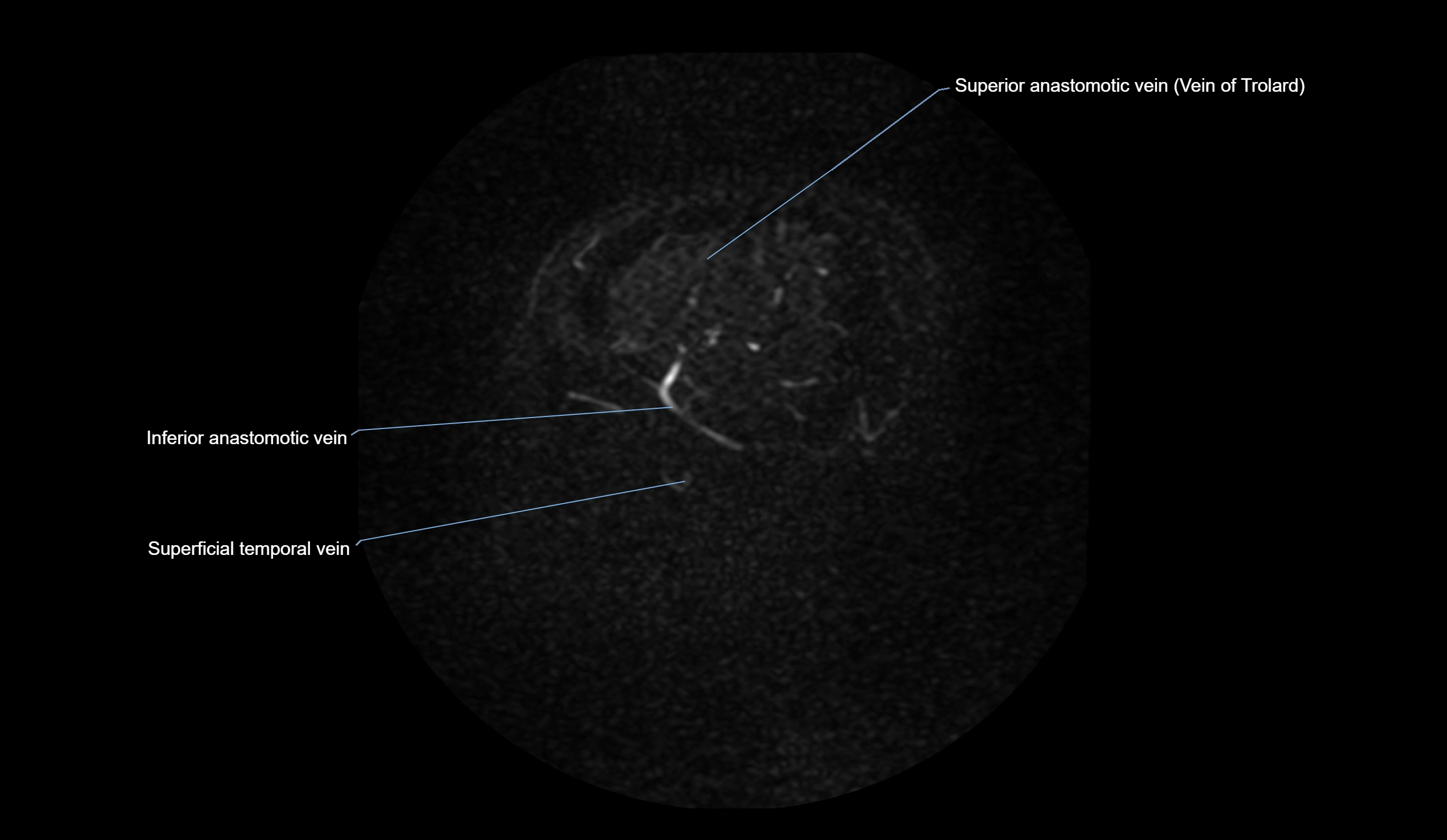 MRV brain sagittal anatomy 3T MRI labelledimages -00074.webp